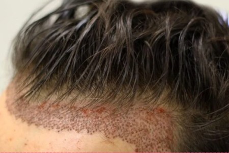 مرکز تخصصی کاشت مو ✨اقساطی✨