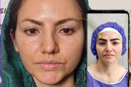 ✅ ☎️ مشاوره رایگان کاشت ابرو👌کلینیک بهار ژیوان