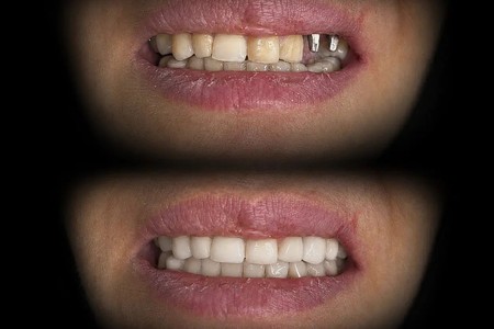 ایمپلنت دیجیتال بدون درد ، ۱۰% تخفیف ویژه تمامی خدمات دندانپزشکی